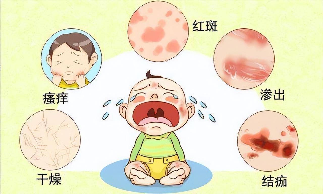 濕疹是怎么引起的，深度解析原因與防治策略，深度解析濕疹成因與防治策略，引發(fā)因素及應(yīng)對方法全知道！