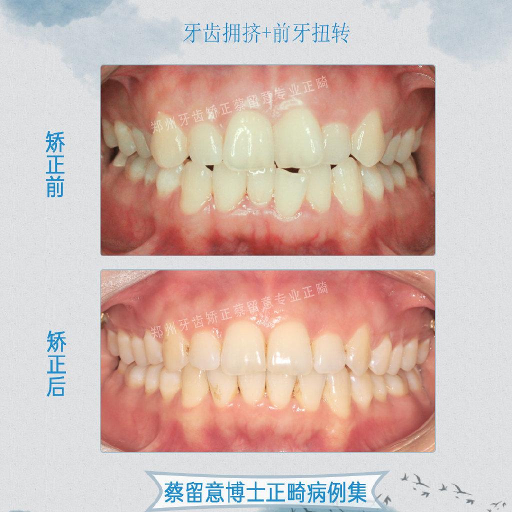 關(guān)于兒童牙齒矯正費(fèi)用，了解牙齒矯正費(fèi)用因素與預(yù)算方案，兒童牙齒矯正費(fèi)用詳解，影響因素與預(yù)算方案指南