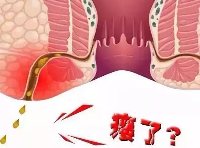 肛周膿腫的深入了解與治療策略，肛周膿腫的詳解與治療策略