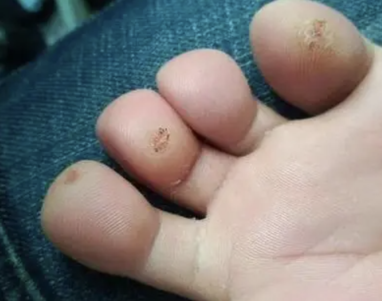 跖疣與雞眼的對(duì)照?qǐng)D片，了解兩者差異，正確識(shí)別治療，跖疣與雞眼對(duì)比，識(shí)別與治療指南，附對(duì)照?qǐng)D片