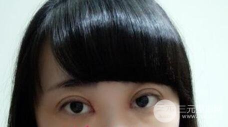 雙眼皮手術(shù)效果展示，不同毫米數(shù)雙眼皮效果圖解析，雙眼皮手術(shù)效果展示與不同毫米數(shù)雙眼皮效果圖解析