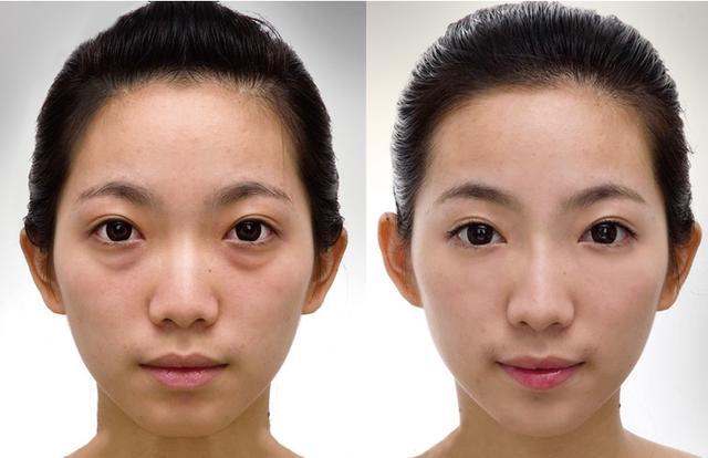 激光去眼袋效果好嗎？需要多少錢？一文解析，激光去眼袋效果及費(fèi)用全面解析