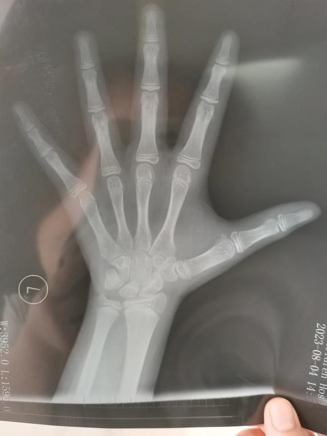 如何判斷骨骼線是否閉合，全面解讀與指導(dǎo)，如何判斷骨骼線是否閉合，全面解讀及指導(dǎo)方法