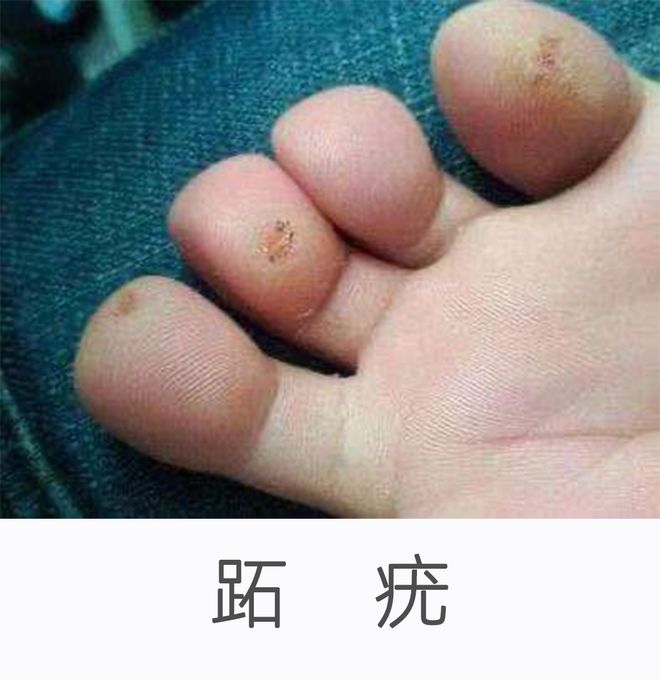 HPV感染的癥狀表現(xiàn)及其影響，HPV感染的癥狀、表現(xiàn)與影響探究