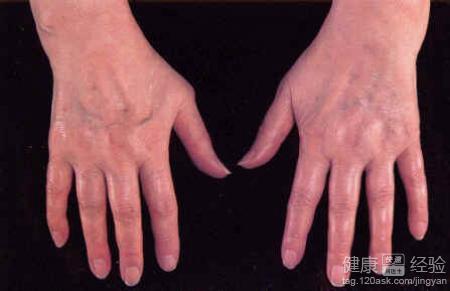 類風(fēng)濕早期10大征兆，了解并預(yù)防關(guān)節(jié)炎的侵襲，類風(fēng)濕早期征兆揭秘，預(yù)防關(guān)節(jié)炎侵襲的十大信號(hào)