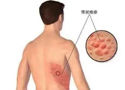 帶狀皰疹圖片，了解癥狀，預(yù)防及治療，帶狀皰疹，圖片解析、癥狀了解、預(yù)防與治療策略