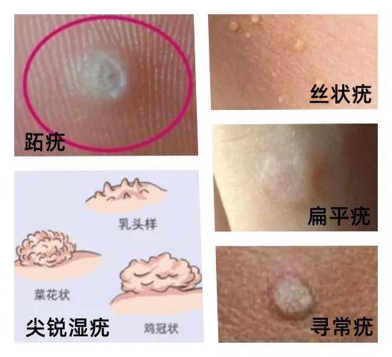 女性初期小疣體圖片及其相關(guān)知識解析，女性初期小疣體圖片詳解與相關(guān)知識解析