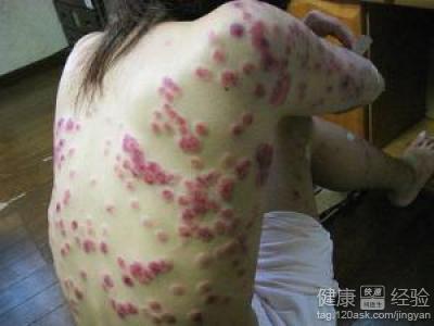 男性梅毒前兆圖片及其相關(guān)解析，男性梅毒前兆圖片與癥狀解析