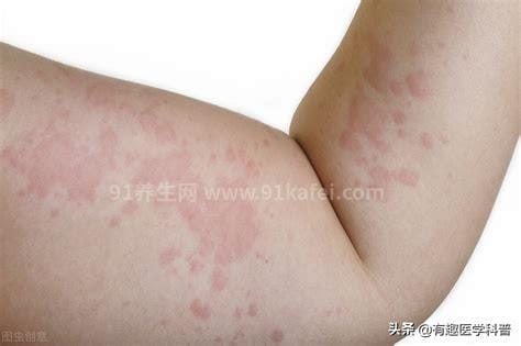 揭秘一個小偏方輕松搞定過敏，讓你遠離煩惱！，小偏方揭秘，輕松抗過敏，遠離煩惱困擾！