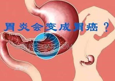 女性胃癌的癥狀與前兆，了解并及早預(yù)防，女性胃癌早期癥狀與前兆，預(yù)防與了解的重要性