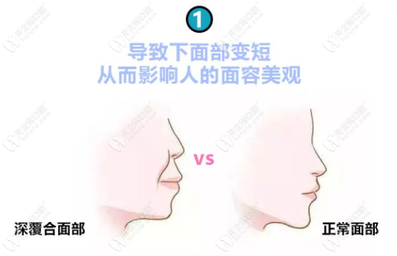 深覆合矯正前后臉型變化，重塑自信微笑，深覆合矯正重塑自信微笑，臉型變化與微笑之美