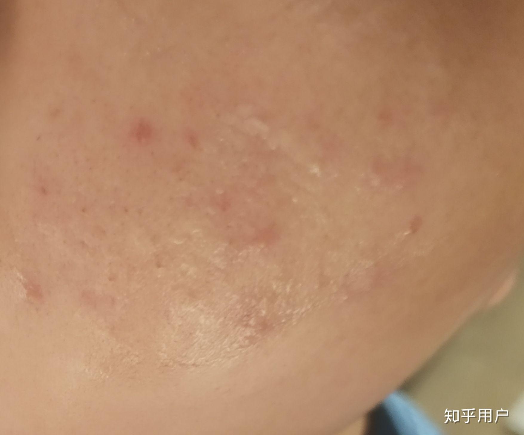皮膚病種類大全，100種常見皮膚病對照及解析，皮膚病種類詳解，常見皮膚病對照及解析大全（100種）