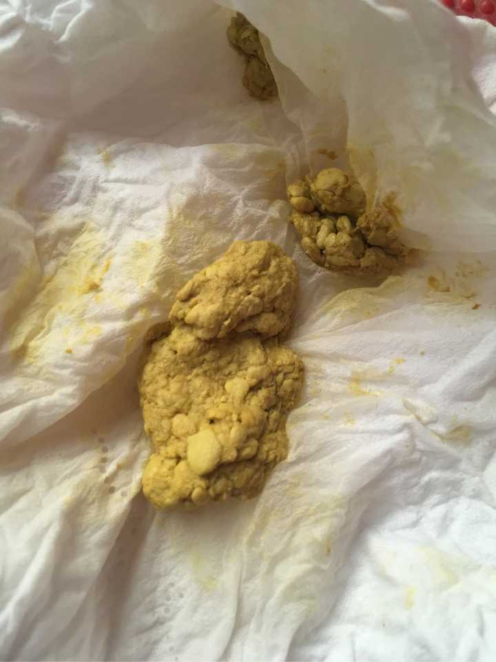 揭秘十天不大便背后的秘密，屎都去哪了？，十天不解便背后的秘密，滯留物去向揭秘