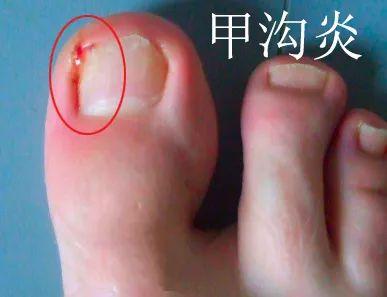 泡一個月醋灰指甲，恢復(fù)健康甲床的秘密武器！，醋泡一個月助灰指甲恢復(fù)健康甲床，秘密武器揭秘！
