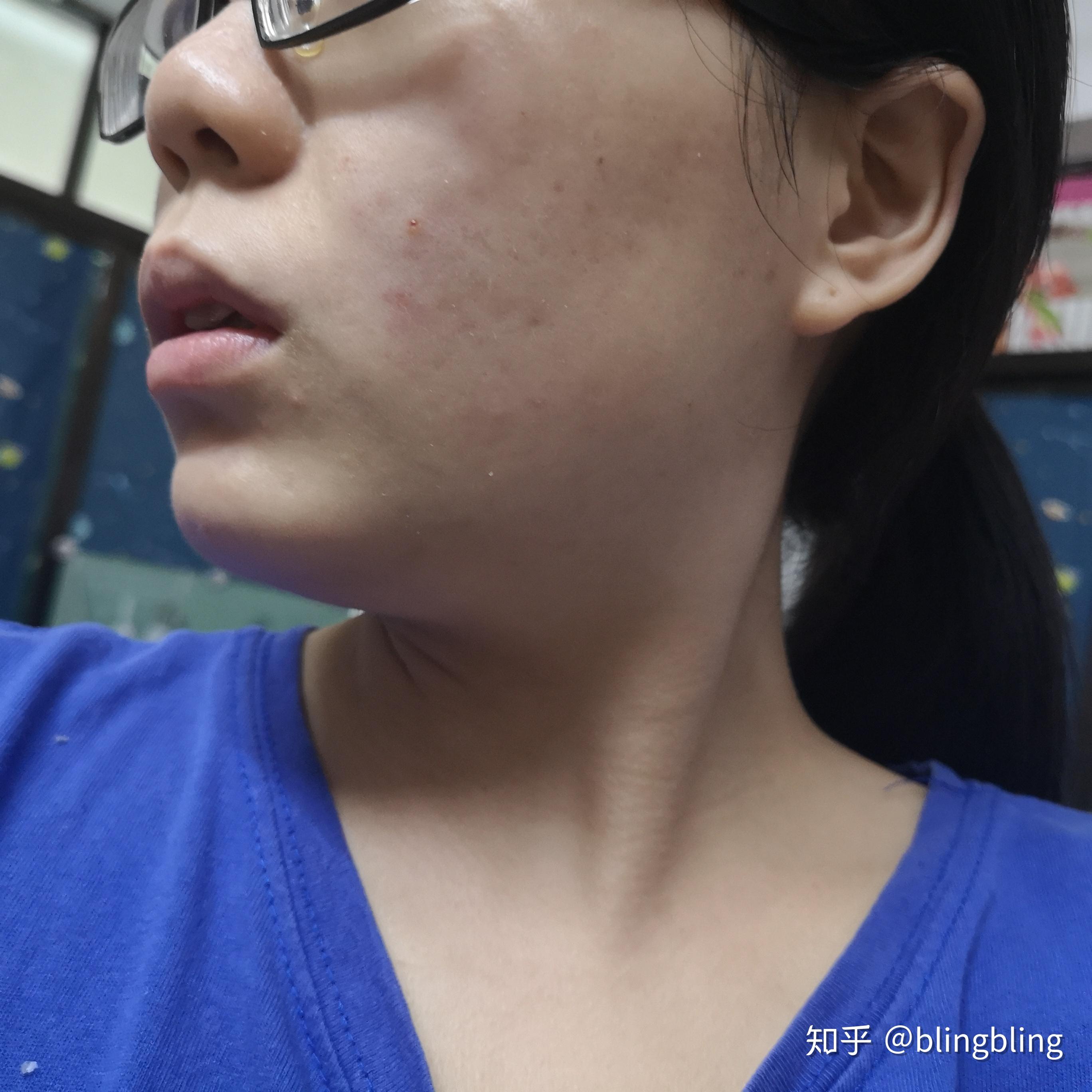 做完光子嫩膚后悔了？真實(shí)經(jīng)歷與解決方案，后悔做光子嫩膚？真實(shí)體驗(yàn)與應(yīng)對策略