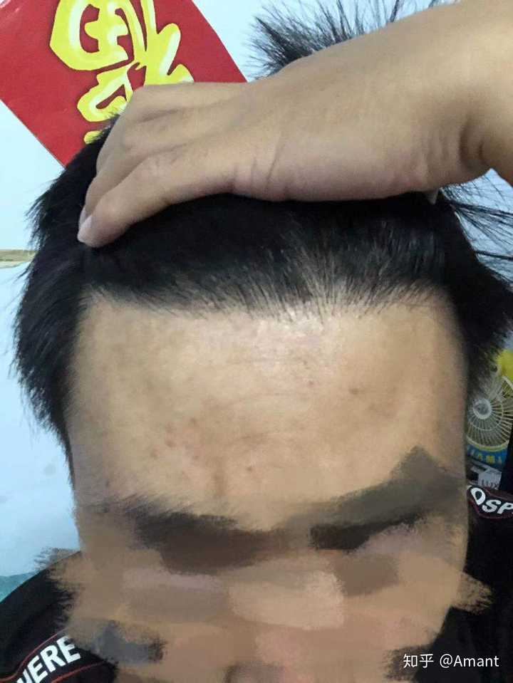 關(guān)于植發(fā)的深度探討，你真的需要這樣做嗎？，植發(fā)深度探討，你真的需要了解是否適合植發(fā)嗎？