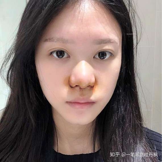不整容怎么讓鼻翼鼻頭縮小，自然縮小鼻翼鼻頭的方法，自然縮小鼻翼鼻頭的方法，不整容讓鼻子更精致！
