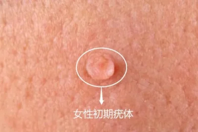 初期小疣體圖片真實(shí)，了解、識(shí)別與應(yīng)對(duì)，初期小疣體圖片真實(shí)展示，識(shí)別、理解與應(yīng)對(duì)方法