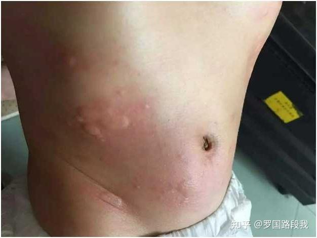 蕁麻疹長(zhǎng)期未治會(huì)引發(fā)何種后果？了解蕁麻疹的潛在風(fēng)險(xiǎn)與影響，蕁麻疹長(zhǎng)期未治可能引發(fā)哪些后果？探究蕁麻疹潛在風(fēng)險(xiǎn)與影響全解析