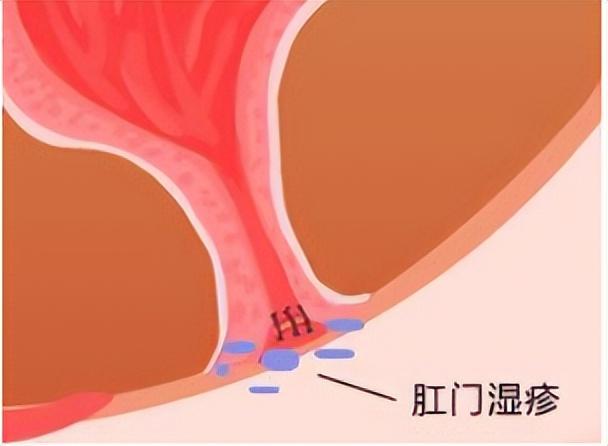 肛門周圍潮濕瘙癢是什么原因，肛門周圍潮濕瘙癢的成因與解決方法