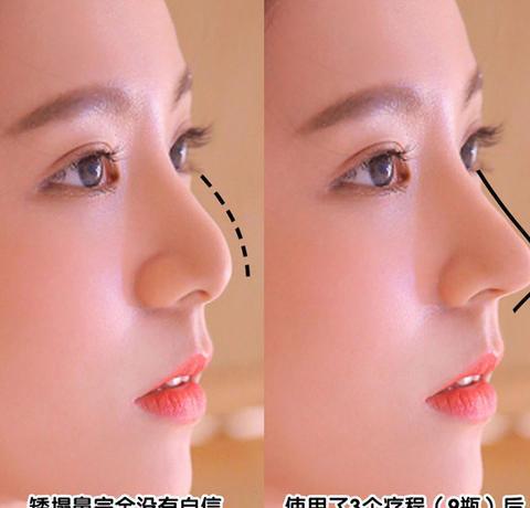 縮鼻翼鼻頭手術(shù)前后對(duì)比照，變化之美，縮鼻翼鼻頭手術(shù)效果對(duì)比，變化之美展現(xiàn)無遺