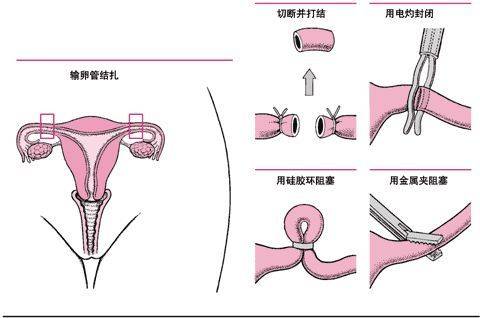 女人結(jié)扎后能否恢復生育能力，深度解析與希望，女人結(jié)扎后能否恢復生育能力，深度解析與生育希望探討