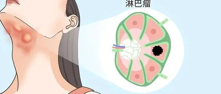 為什么說淋巴癌是幸福癌？揭示淋巴癌的真相與誤解，淋巴癌真相揭秘，為何被稱為幸福癌？