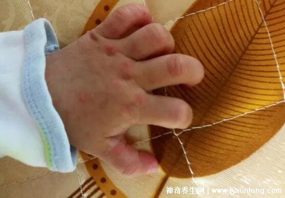 手足口病癥狀初期圖片，了解、預(yù)防與應(yīng)對(duì)，手足口病的初期癥狀圖片，了解、預(yù)防與應(yīng)對(duì)策略