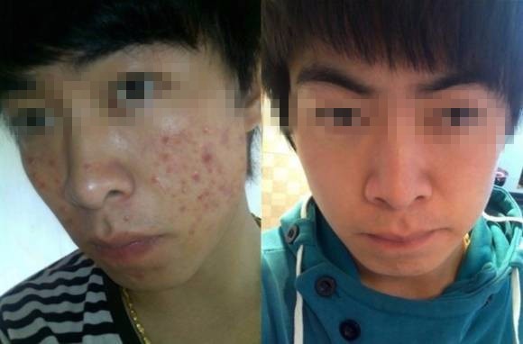 青春痘最佳治療方法