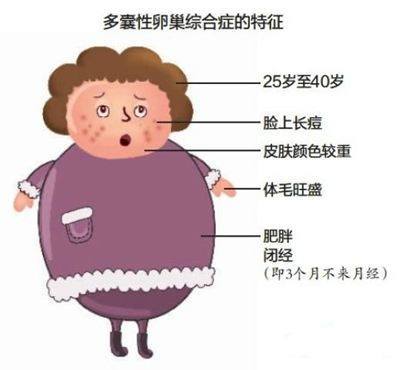 多囊卵巢綜合征，全面解析與應(yīng)對策略，多囊卵巢綜合征詳解，全面解析與應(yīng)對策略