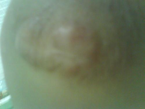 疤痕修復(fù)手術(shù)費(fèi)用詳解，一般多少錢？，疤痕修復(fù)手術(shù)費(fèi)用全面解析，手術(shù)費(fèi)用究竟是多少？