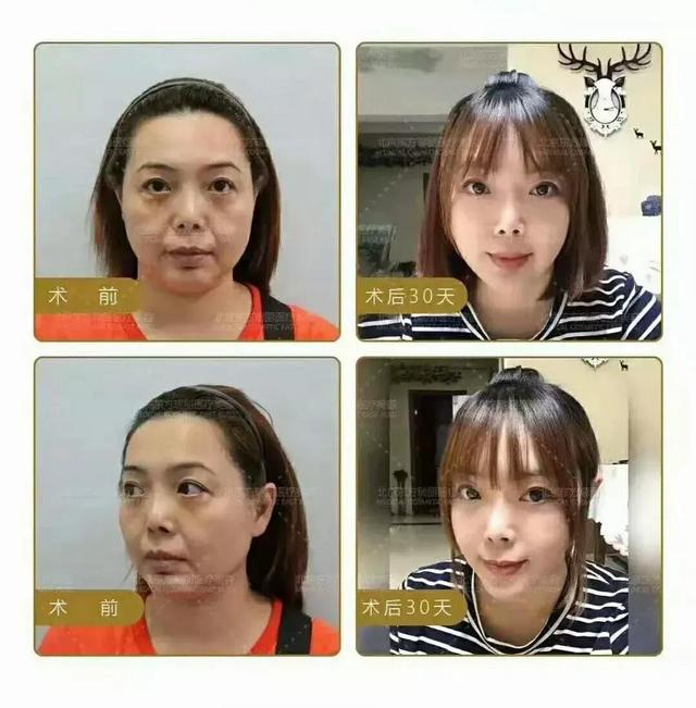 面部提升的最佳方法，針對50歲肌膚的抗衰老策略，針對五十歲肌膚的抗衰老策略，面部提升最佳方法
