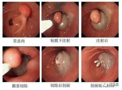 胃鏡檢查結(jié)果揭秘，十個患者九個發(fā)現(xiàn)息肉，究竟是何原因？，胃鏡檢查結(jié)果揭示，多數(shù)患者發(fā)現(xiàn)息肉，原因究竟何在？