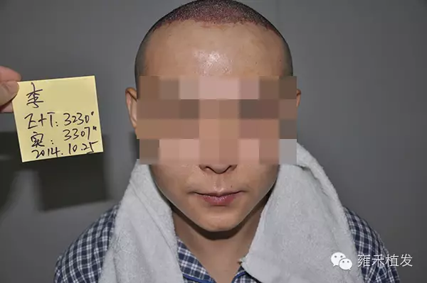 植發(fā)有用嗎?可以維持多久