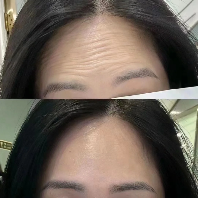 去抬頭紋的最好方法有哪些，揭秘最佳去抬頭紋方法，輕松告別皺紋困擾！