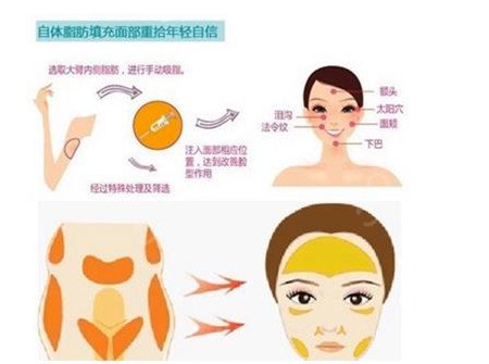 自體脂肪填充面部，持續(xù)時間的因素與延長保持效果的策略，自體脂肪填充面部，影響持續(xù)時間與延長保持效果的策略探討