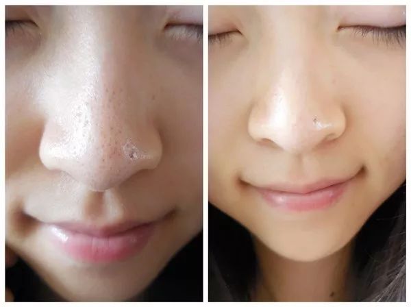 如何輕松去除黑頭，簡單有效的黑頭去除方法，輕松有效的黑頭去除方法與實(shí)用技巧