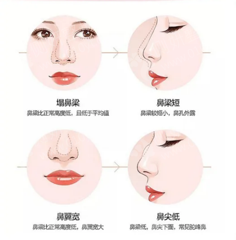 最安全的永久隆鼻，全面解析與指南，全面解析與指南，最安全的永久隆鼻方法