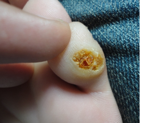 雞眼初期圖片，識別、預防與治療，雞眼初期識別、預防與治療方法及圖片指南