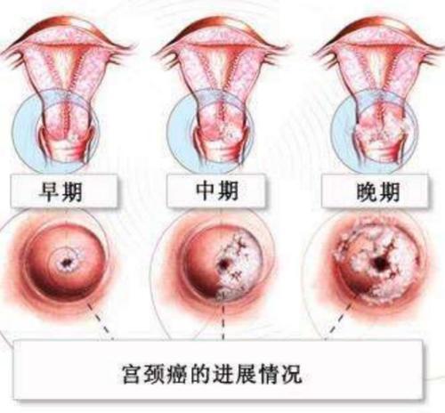 女性HPV病毒早期癥狀，了解、預(yù)防與應(yīng)對，女性HPV病毒早期癥狀詳解，預(yù)防與應(yīng)對策略