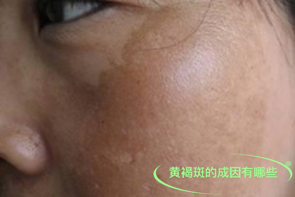 黃褐斑怎么引起的，成因深度解析，深度解析黃褐斑成因，引發(fā)黃褐斑的多元因素探討