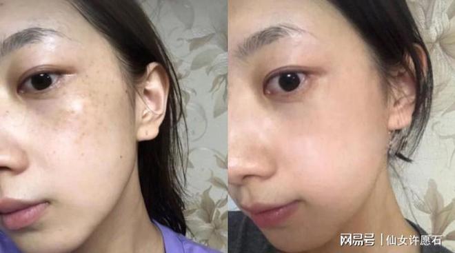 長(zhǎng)斑怎么辦？最有效的祛斑方法大全，長(zhǎng)斑不用愁，最有效的祛斑方法全攻略