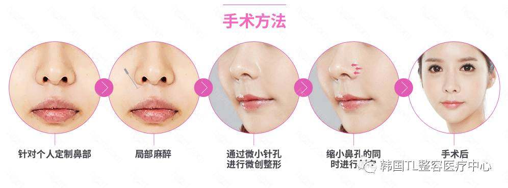 不開刀縮小鼻頭方法，不開刀縮小鼻頭技巧或方法