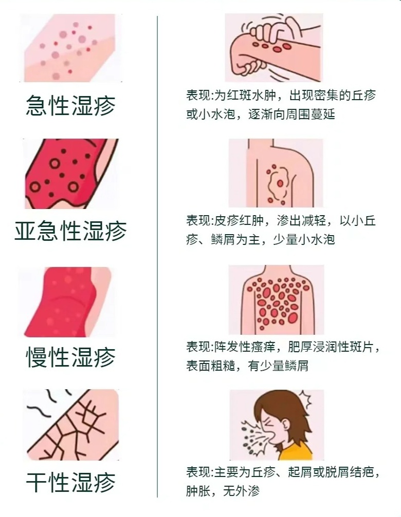 一張圖教你辨別濕疹，全面解析濕疹癥狀與應(yīng)對之策，圖解濕疹癥狀解析及應(yīng)對之策，輕松辨別濕疹，全面護(hù)航肌膚健康