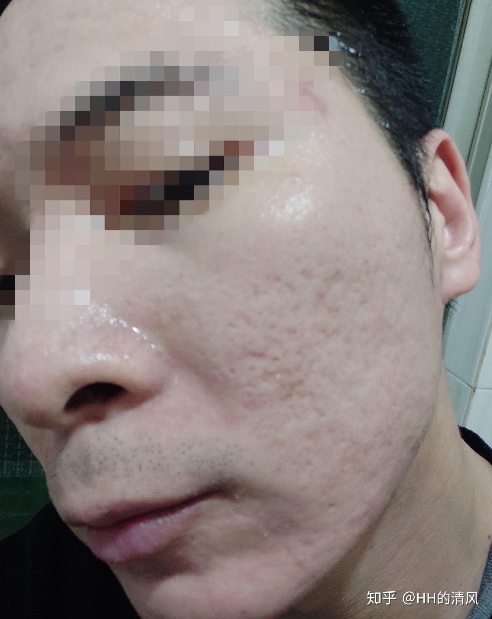 點陣激光痘坑治療經(jīng)歷分享，八次治療后的效果與反思，點陣激光痘坑治療經(jīng)驗分享，八次治療后的效果及反思
