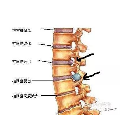 椎間盤4/5突出最佳治療策略與方案解析，椎間盤4/5突出最佳治療策略解析及方案探討