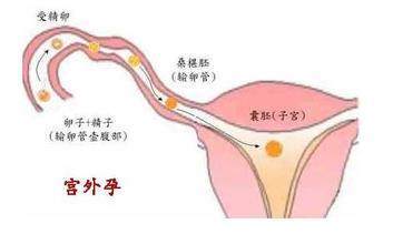 宮外孕的初期癥狀及其識(shí)別與應(yīng)對(duì)，宮外孕初期癥狀識(shí)別與應(yīng)對(duì)指南