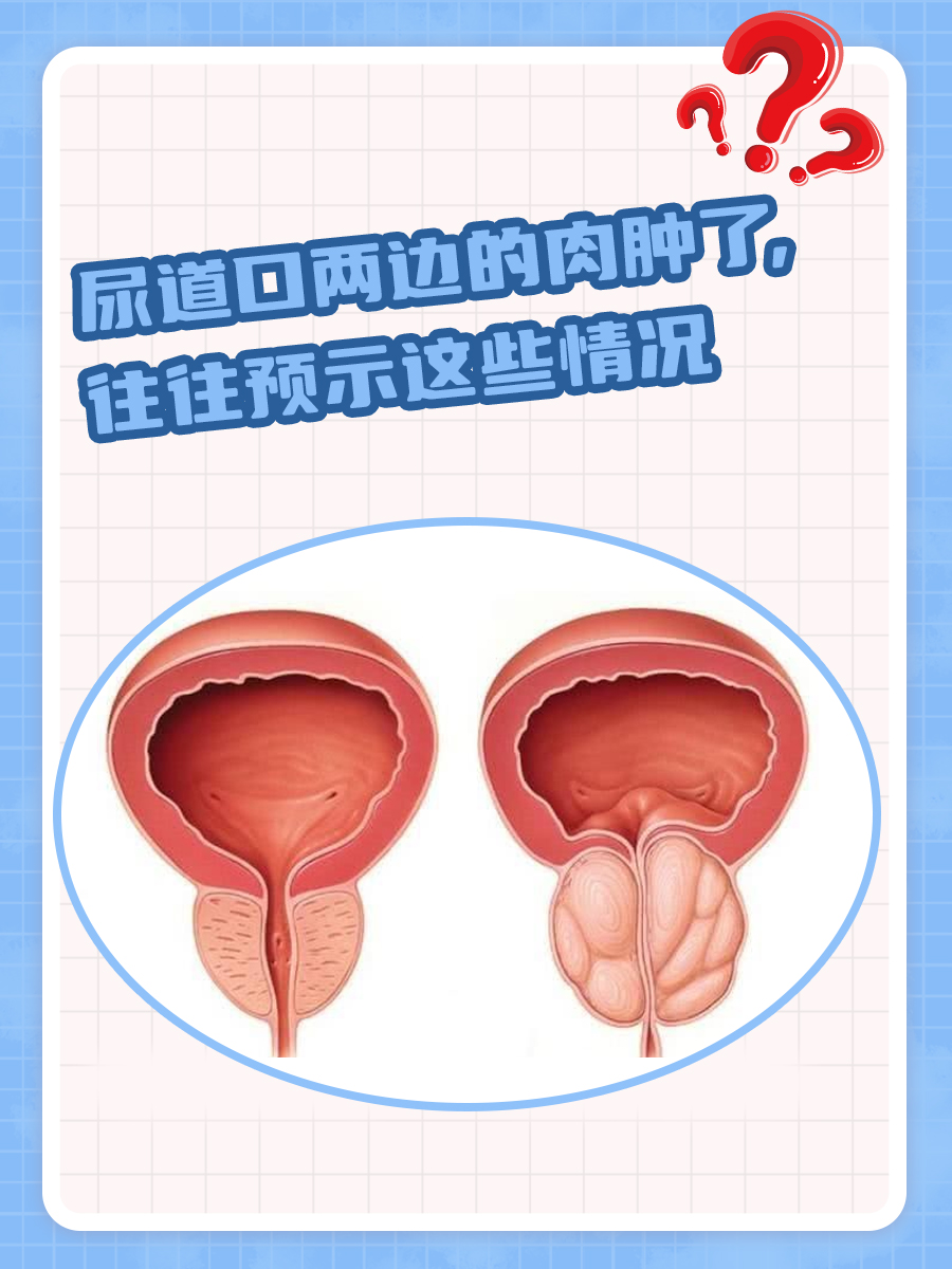 女尿道口一側(cè)翻開有白色米粒，了解、關(guān)注與正確處理，女性尿道口一側(cè)白色米粒狀物解析與正確處理指南