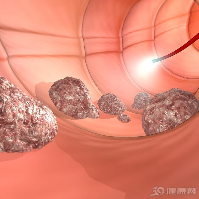 腸癌早期癥狀，了解并及早預(yù)防腸癌的重要性，腸癌早期癥狀解析，預(yù)防腸癌，早期識別關(guān)鍵