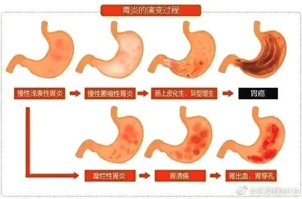 萎縮性胃炎怎么治療才能徹底治愈？全面解析最佳治療方案，萎縮性胃炎全面治愈方案解析，最佳治療方案探討